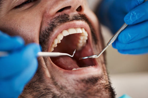 Best Emergency Tooth Extraction in Marshallville, GA